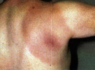 Bull's-eye rash (erythema migrans)